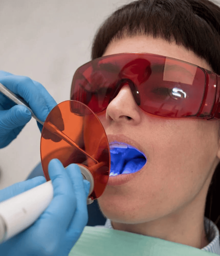 Tooth Colored Fillings