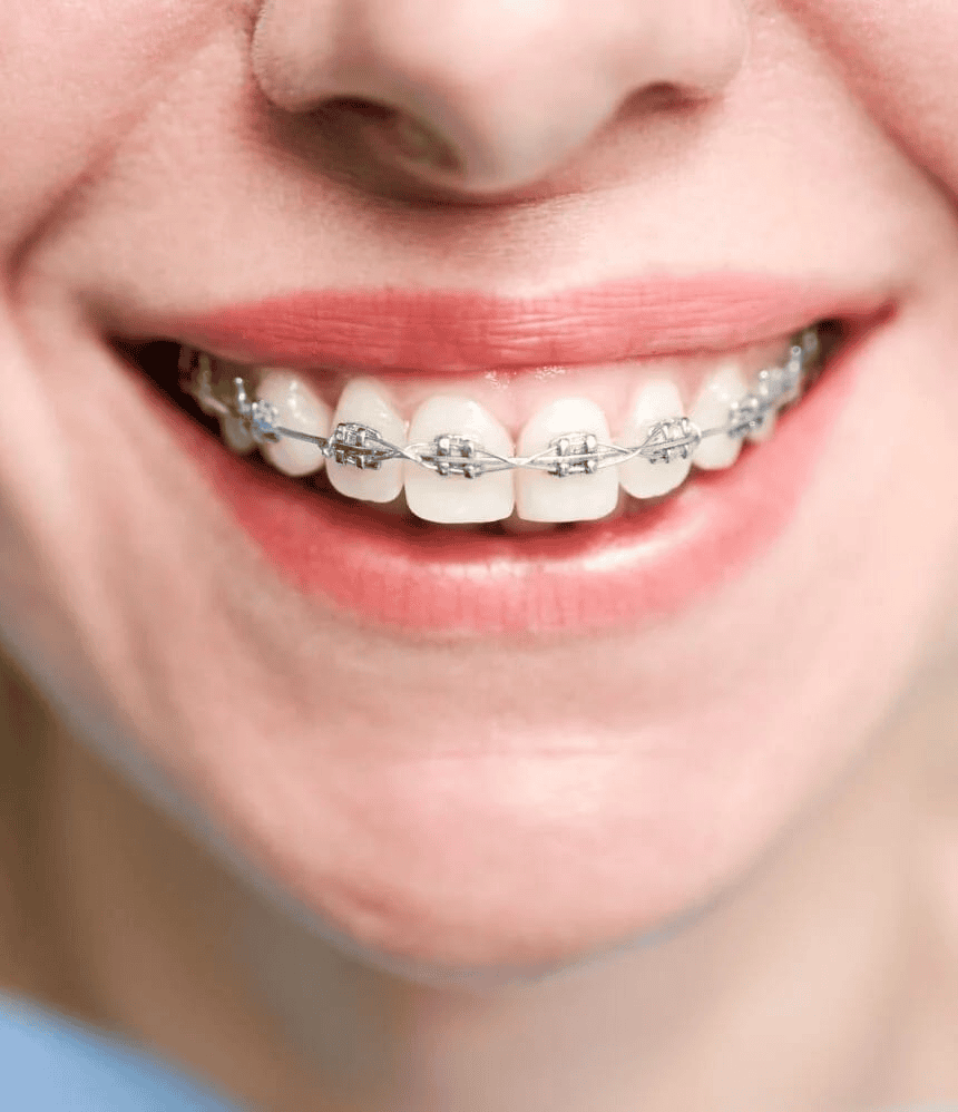 Braces and Invisalign