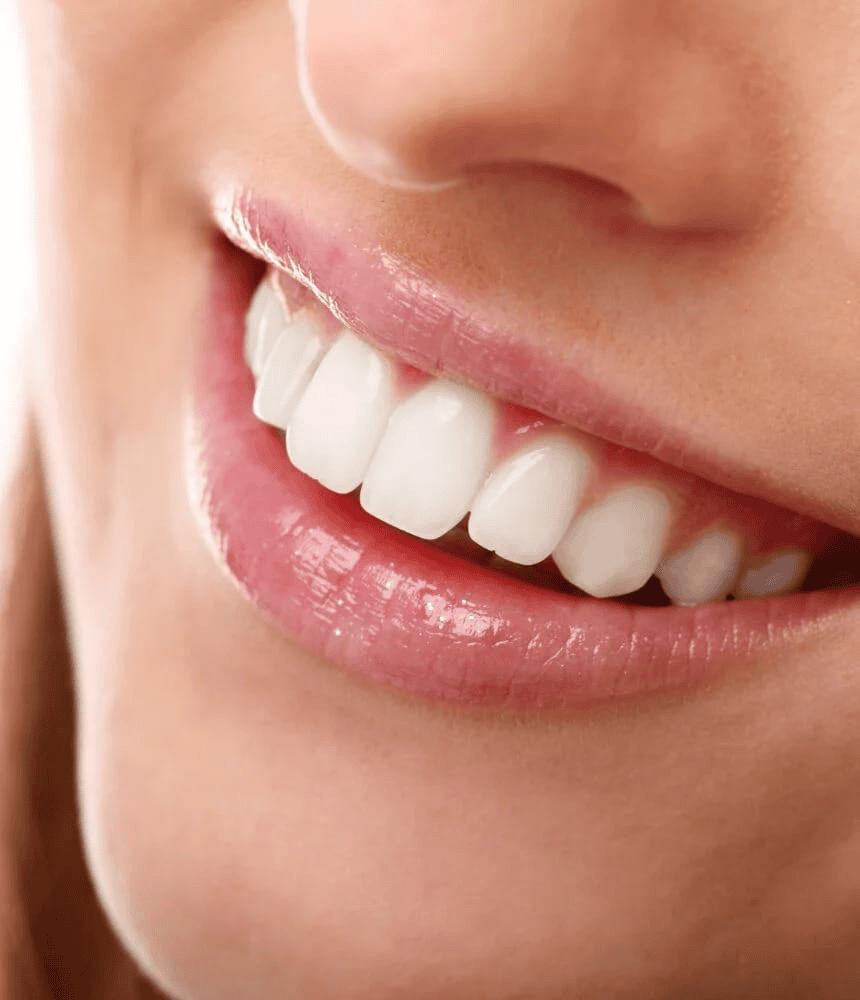 Teeth Whitening